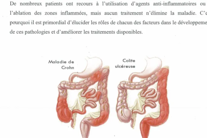 Figure 10. Les principales maladies inflammatoires intestinales 