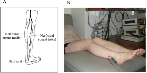 Figure 11. Stimulation électrique transcutanée du nerf sural 