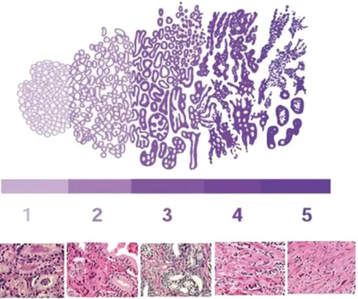 Figure 2: The classical representation of the Gleason grades 1-5.  