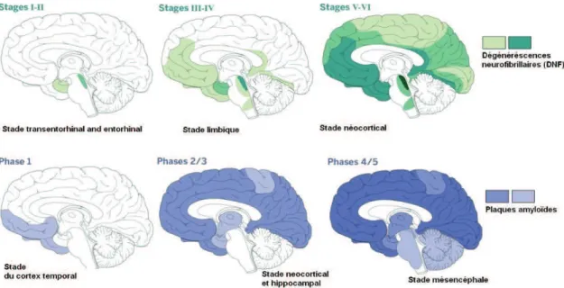 Figure  7  :  Accumulation  spatio-temporelle  des  dégénérescences  neurofibrillaires  et  des  plaques  amyloïdes au cours de la maladie d’Alzheimer
