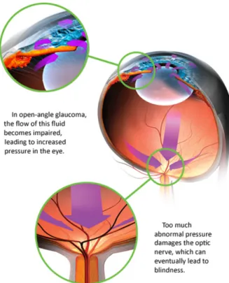 Figure 2.12 – In most cases of open-angle glaucoma accumulation of fluid in the eye increases IOP which in turn causes damage to blood vessels and optic nerve