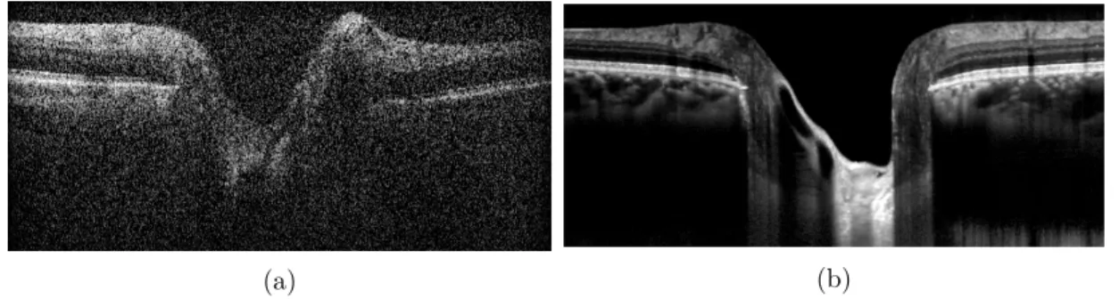 Figure 5.1 – OCT image comparison. a) OCT image from the sequence acquired at 20 Hz , made of 2 averaged B-scans with a Spectralis quality score ( Q ) of 18 dB 