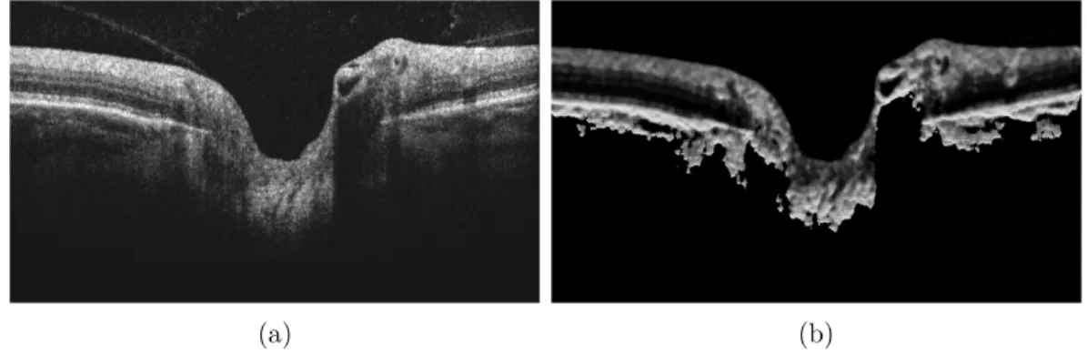 Figure 5.2 – Preprocessing example: a) Original ONH image showing peripapillary vitreous detachments on both regions, nasal and temporal