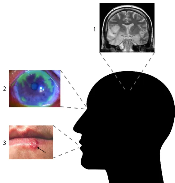 Figure 5 : Principales pathologies engendrées par le VHS-1 