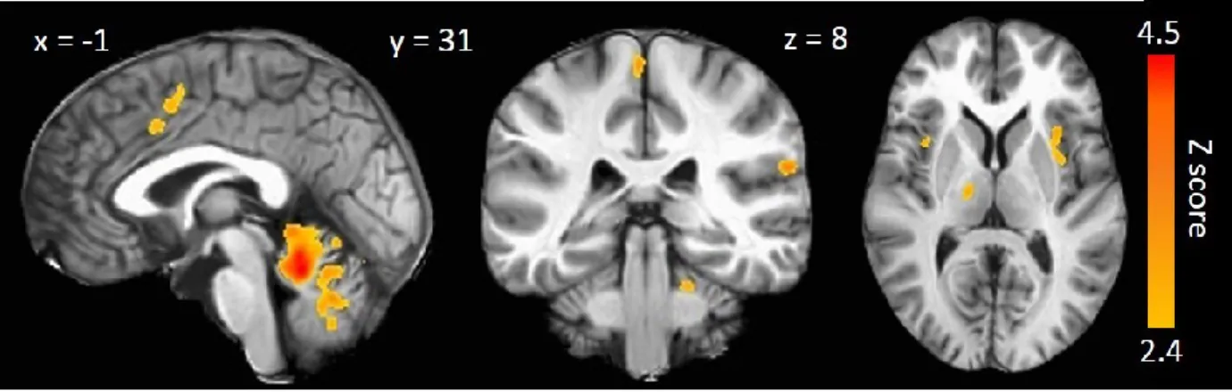 Figure 3. Mean functional brain activity across all subjects for the pain-related session
