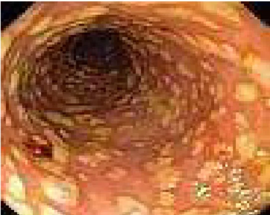 Figure 1 : Colite pseudomembraneuse (Carrion et al., 2010) 