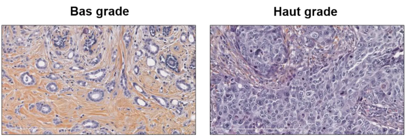 Figure 1.3   Grade SBR-EE. Coupes histologiques d’un carcinome mammaire de bas grade (gauche) et de haut  grade (droite)