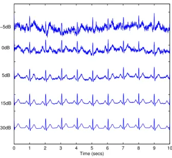 Figure 2.5 – Ten-second excerpts from the noisy synthetic ECG signals.
