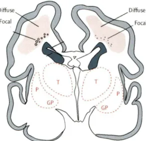 Figure 2.  Représentation  d'une  coupe  coronale  d'un  cerveau  de  nouveau-né  prématuré  (28  semaines  de  gestation)  illustrant  les  régions  cérébrales  présentant  le  plus  souvent  des  dommages