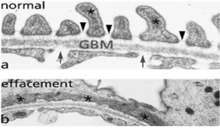 Figure 12 : Micrographies électroniques à transmission des capillaires glomérulaires humains