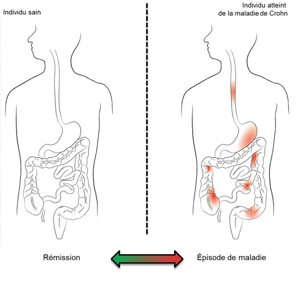 Figure 1 : Représentation de la maladie de Crohn. 