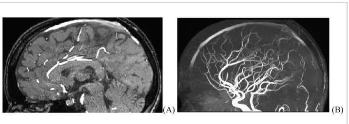 Figure 2. Exemple d’image artérielle de type TOF MRA 