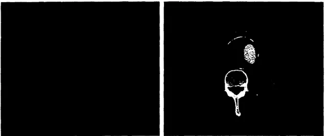 Figure 1.9 - Deux images  d'une TDM avec  des contrastes différents.  Ces images ont  512  x  512 pixels