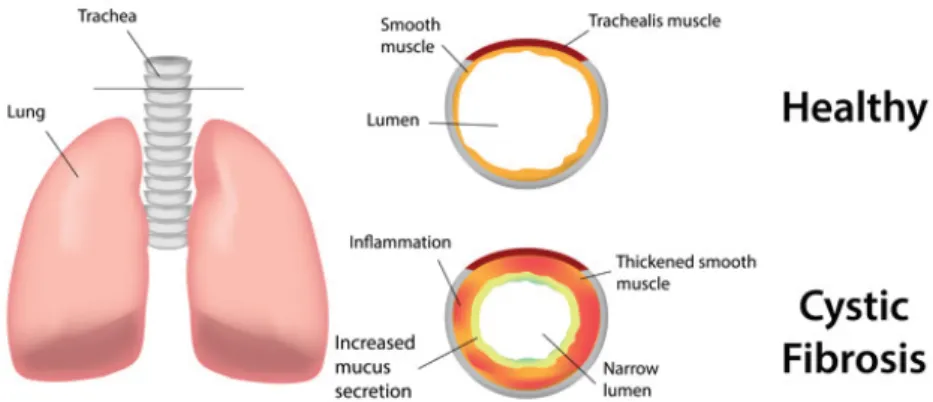 Figure 2.10 Diérence entre des bronches normales et des bronches de per- per-sonnes atteintes de mucoviscidose