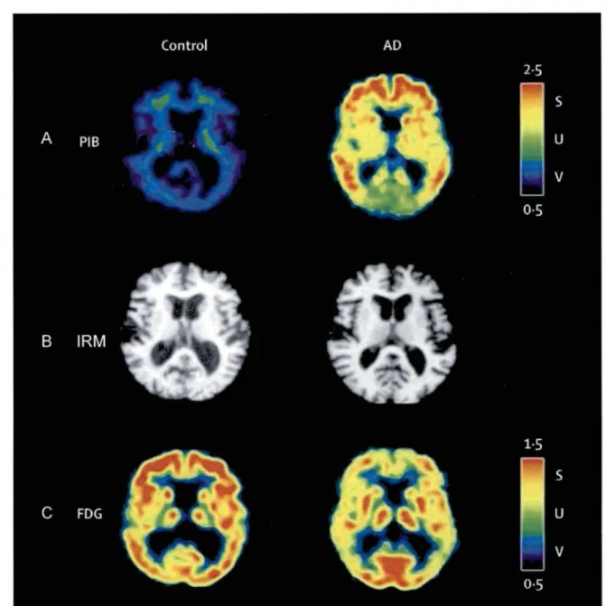 Figure 1:  Comparaison du TEP-PIB (A), d'un IRM  (B) et d'un TEP-FDG (C) chez  une personne âgée avec cognition normale et atteinte de MA (modifié de Blennow,  2006) 