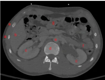 Figure 2.2 Coupe abdominale d’un humain prise par un scanner TDM [10]. On y voit les côtes (a), le foie (b), les reins (c), la colonne vertèbral (d), l’aorte (e), l’intestin grêle (f) et le gros intestin (g).