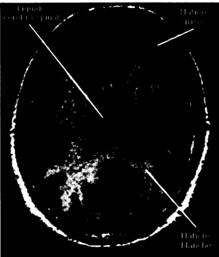 figure 1 - Image anatomique pondérée T1 de la tête d'un homme adulte en plan axial,  montrant le LCS, la matière grise du cortex ainsi que la matière blanche sous-jacente