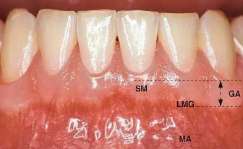 Figure 3 : Aspect clinique de la gencive saine chez l'adulte, Philippe  Bouchard   - SM : sillon marginal – GA : gencive attachée –                        LMG : ligne mucogingivale – MA : muqueuse alvéolaire 