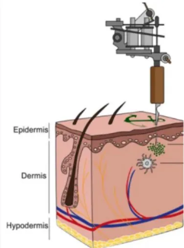 Figure 5 : Insertion de pigments  dans le derme à l'aide d'un  dermo-graphe lors du processus de  ta-touage, Schreiver, I et coll