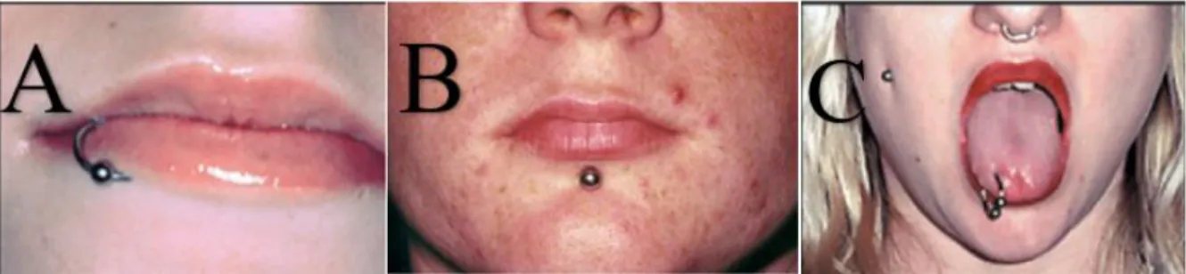 Figure 18 :  A : piercing frein lingual, Ventolini G et coll 2016   -   B : piercings uvule palatine     -   C : piercings lin- lin-guaux, Pramod RC et coll 2012     