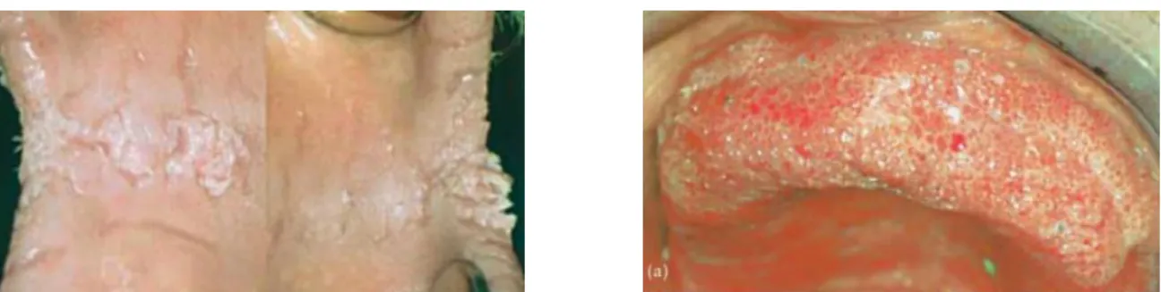 Figure 5 : Fissures et papillomes rétro-commissuraux  Figure 6 : Lésions papillomateuses maxillaires 