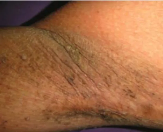 Figure 7 : Hyperkératose et hyper pigmentation de la peau des aisselles 
