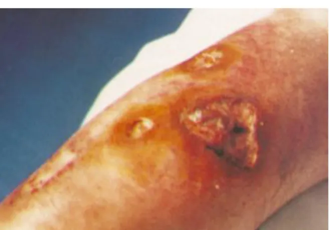 Figure 12 : Lésions cutanées du Pyoderma  gangrenosum 