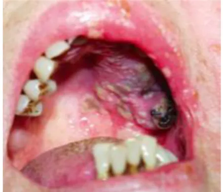 Figure 16 : Lésions muqueuses orales dues au Zona 