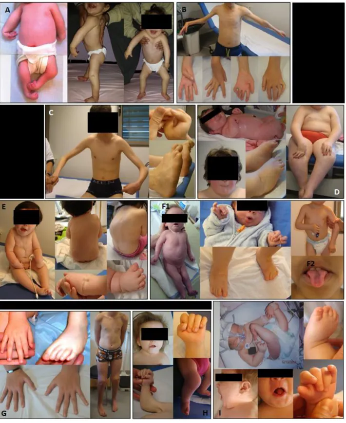 Figure 5. Pictures of AMC patients of our cohort. A. Typical Amyoplasia congenita involving four limbs (subject  87)
