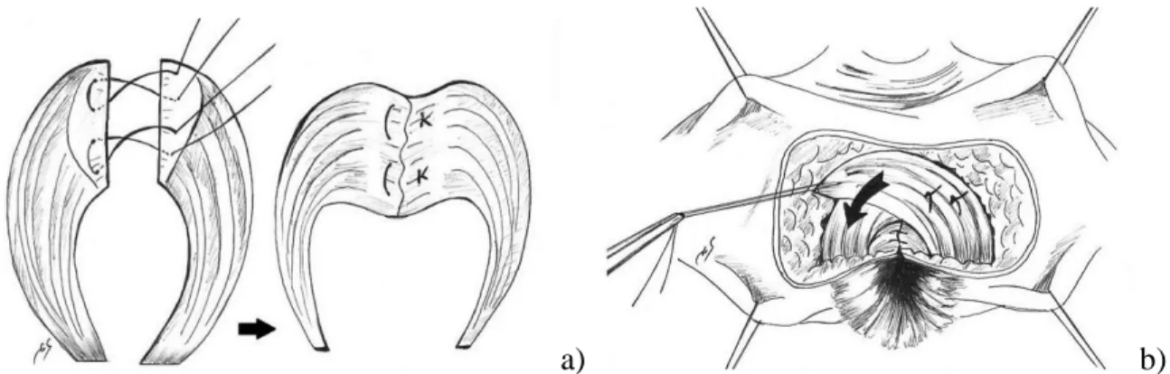 Figure 6 : Illustrations des deux techniques de réparation : a) Technique du rapprochement ;  b) Technique du recouvrement  