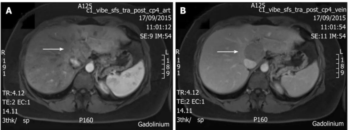 Figure 1  T1 weighted magnetic resonance imaging with gadolinium injection, showing a 50-mm tumor in segment 1 (arrow)