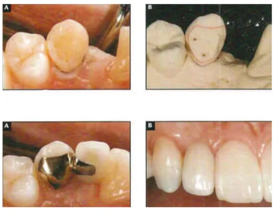 Figure 9 : Préparation et réalisation d’un bridge cantilever lié à une canine (56). 