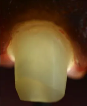 Fig. 20 : Continuum biomécanique assuré par une RMIPP 