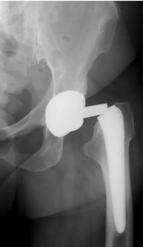 Figure 7 : Fracture col modulaire type C 