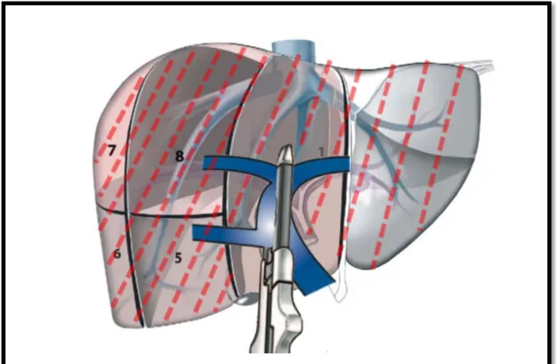 Figure 9 : clampage et anatomie de type 1. Extension de la zone d’ischémie à gauche 