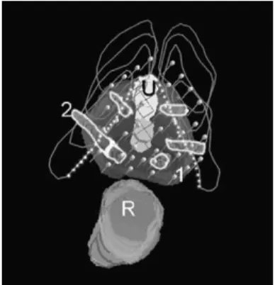 Fig. 2. The interference of the pelvic bone arch. All the lines designed for I 125 brachytherapy (Bt) (1) cannot be implanted due to an important bone arch interference delineated by the dotted line.