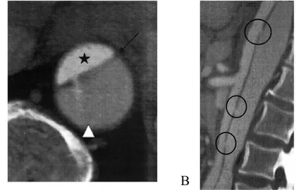 Fig 3: Angio-TDM montrant une dissection aortique type B 