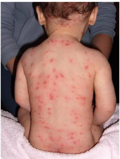 Illustration 1: Lésions élémentaires d’une varicelle