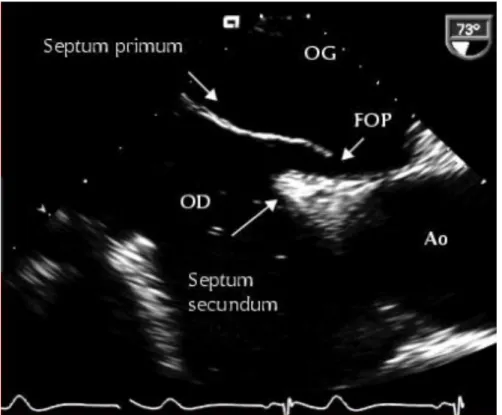 Figure 5 : Visualisation en ETO du septum interatrial avec ouverture du FOP  entre septum primum et secundum 