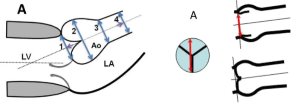 Figure 6 : Mesures des dimensions de l’aorte ascendante (conventions ASE) 