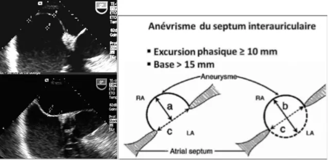 Figure 7 : Evaluation d’un ASIA (c : base / a et b : excursion phasique) 