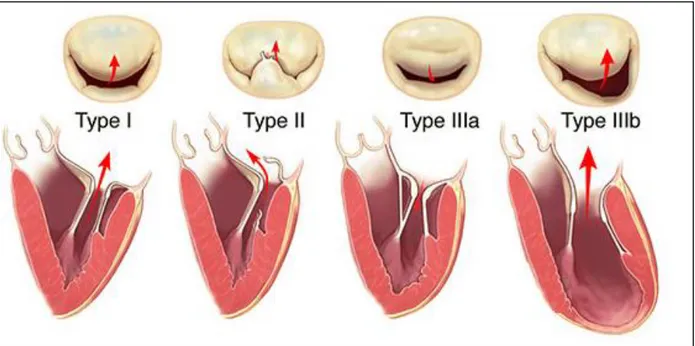 Figure 2 : Mécanismes d’IM selon la classification de Carpentier. 