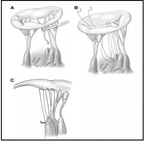 Figure 8 : Annuloplastie mitrale (A)  dilatation annulaire après reconstruction du feuillet postérieur  (B)  sélection de la taille de l’anneau (C) sutures en place autour de l’anneau (D) Résultat final