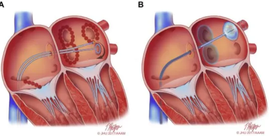 Figure  4 :  Vue  schématique des  cathéters  d’ablation  de  FA :  A.  Lésions  créées  autour  des  veines  pulmonaires  après applications par le cathéter de radiofréquence