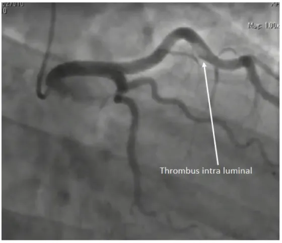 Figure 8 Thrombus intra luminal au niveau du segment moyen de l'artère interventriculaire antérieure chez un patient de 28  ans fumeur de cannabis quotidiennement