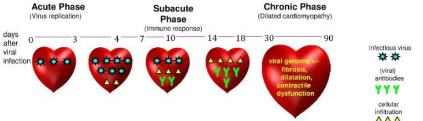 Figure 3 : Phases de développement d’une cardiomyopathie dilatée (Kindermann et al, Update on Myocarditis