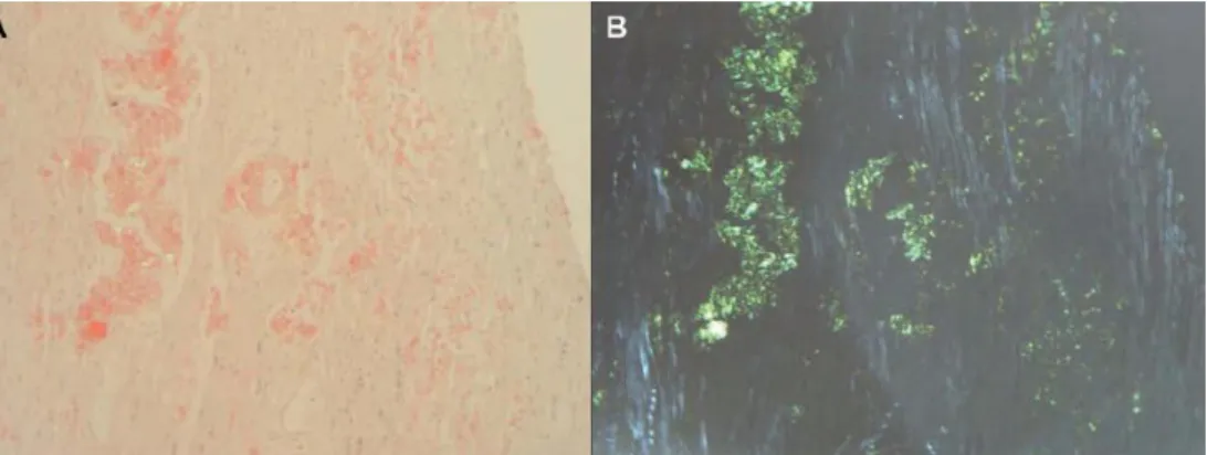 Figure 1 :Coloration au rouge Congo du tissu myocardique d’un patient atteint d’une 