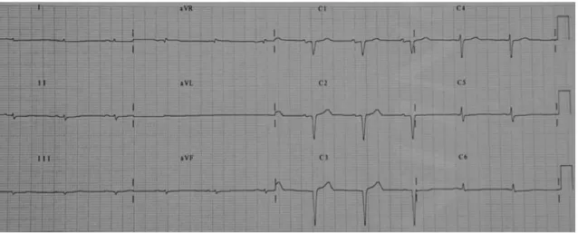 Figure 2: ECG typique d’une amylose cardiaque avec un microvoltage des QRS et un rabotage des  ondes R en antéro septale