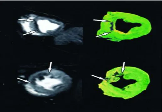 Figure 7 : Corrélation entre l’obstruction microvasculaire (MO) détectée à l’IRM et  par la Thioflavin-s