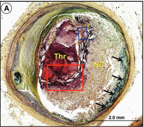 Figure  4 :  Rupture  de  plaque.  Thrombus  occlusif  endoluminal  aigu  (  Thr),  avec  large  noyau nécrotique (NC) et disparition totale de la chape fibreuse séparant précédemment  ces deux entités histologiques